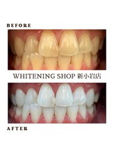 ホワイトニングショップ 新小岩店/短期間で最大限に白く