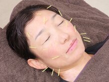 しらとりスポーツサポートマッサージ 鍼灸院 神田/鍼灸施術/美容鍼/美顔鍼