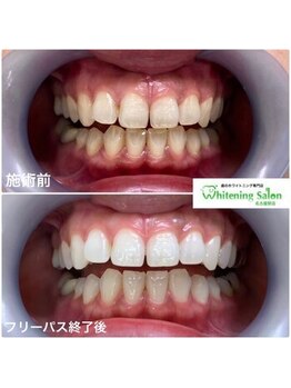 ホワイトニングサロン 名古屋駅店/【ホワイトニング施術例】