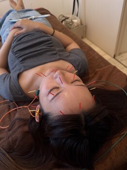 ひかり鍼灸整骨院 南草津/☆美容鍼☆お顔がスッキリ♪