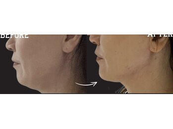 ルキア(LUKIA)/小顔【初回お試し】　施術１回　