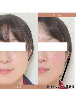 リアン バイ 太陽の月整骨院(Lien)/EMS×リンパで小顔ケア