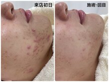 ソワン ドゥ シャルマン(soin de charmant)/長年悩んできたニキビに終止符♪