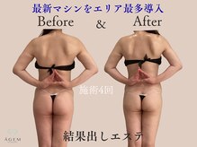 アージェム(AGEM)の雰囲気（背中まわりもスッキリ<インディバ/痩身/ハイパーナイフ>）