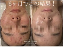 クレア(CLEA)/６ヶ月で行う肌質改善