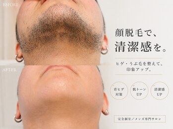 テディベース(TEDDY BASE)/スッキリ爽快、メンズ顔脱毛