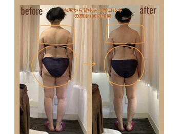 レアフィート(Rheafeet)/症例写真です。