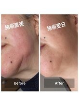 エステシオン(ESTESiON)/ハーブピーリングBeforeAfter