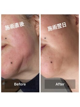 エステシオン(ESTESiON)/ハーブピーリングBeforeAfter