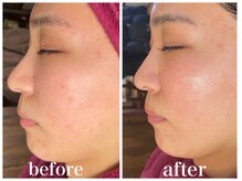 ルー ハナレ 神戸岡本 摂津本山店(Luu HANARE)/フェイスライン小顔　３回