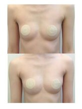 ベッピン(Beppin)/バストアップ症例写真