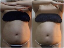 ツボミ(TSUBOMI)/モニター様　before・after