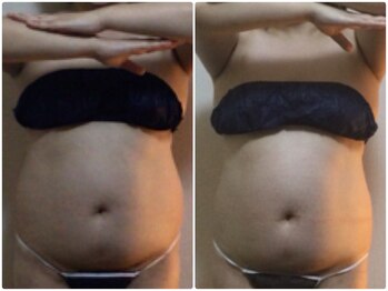 ツボミ(TSUBOMI)/モニター様 before・after