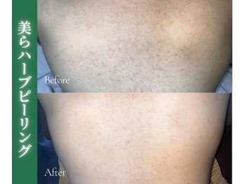 アイランドハーブ 沖縄おもろまち店/ハーフピーリング