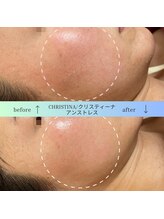 GRACETHOUSAND(グレイスサウザンド)/乾燥/ニキビケア/赤ら顔/敏感肌