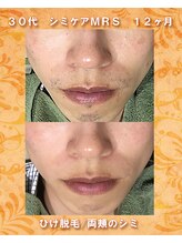 ナイア(naia)/アクアヴィーナス使用症例