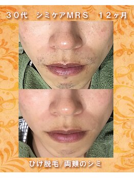 ナイア(naia)/アクアヴィーナス使用症例