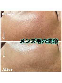 ミノア 大野城店(MINOA)/大人気!メンズ毛穴洗浄