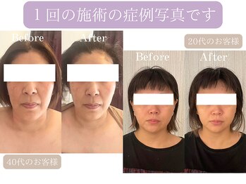 ビジュー(Be-joux)/小顔・リフトアップの症例写真
