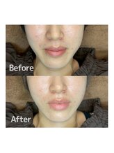 ヴィヴ フォー アール(VIV for R)/肌荒れ改善　20代女性