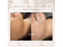 モア(moa)の雰囲気（毎朝鏡を見るのが楽しくなる！エクソソームハーブピーリング♪）