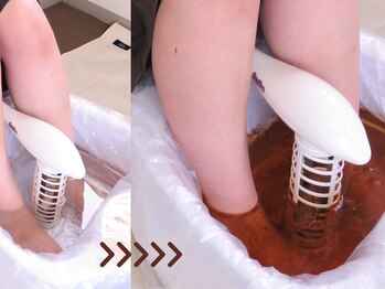 キュアフロウ 新潟巻の写真/【むくみ放置厳禁】減塩してもダメ…本気の生活改善を通告されたら,脂肪細胞が巨大化する前に解消が必須！