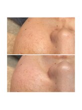 ホワイトワックス 京都四条烏丸(WHITE WAX)/《全顔》フェイシャルワックス