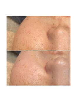 ホワイトワックス 京都四条烏丸(WHITE WAX)/《全顔》フェイシャルワックス