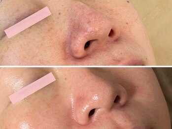 エイプリルフールズ(April fools)/【40代】大満足の黒ずみケア