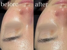 ルテア(Retea.)/毛穴洗浄&ハーブピーリング