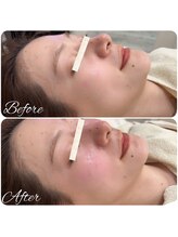 ビースキン(be-skin)/韓国式肌管理before→after