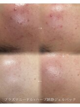 アエ(ae)/プラズマ×ハーブ鎮静パック