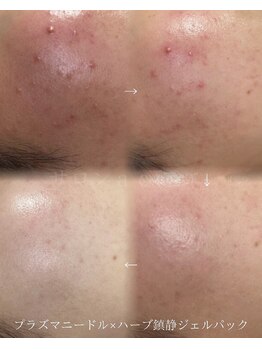 アエ(ae)/プラズマ×ハーブ鎮静パック