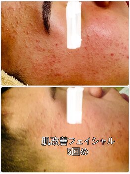 ジュエルビューティー(Jewel Beauty)/ニキビ肌