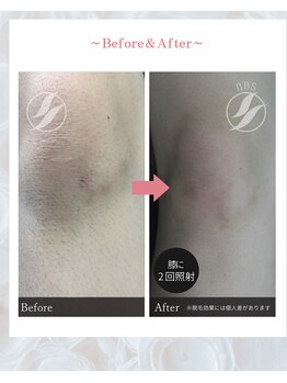 ノノ(nono)/膝の脱毛