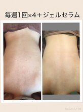 ベルビー エルエル岡崎店/背中ニキビ・黒ずみ改善