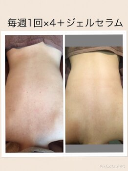 ベルビー エルエル岡崎店/背中ニキビ・黒ずみ改善