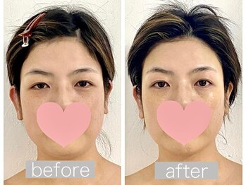 ステラルーテ(Stella lute)/脳洗浄4回集中改善コース 1回目