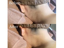 ビマナ 小岩店(NU美Mana)/【うなじ脱毛】