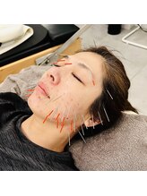 銀座鍼処 カナウ(KANAU)/40代からの鬼ルート美容鍼