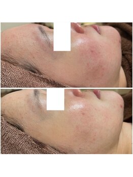 カヌヌ(Kanunu)/肌質改善トリートメント