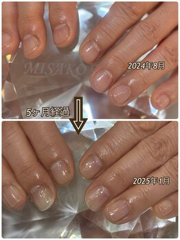 ネイルケア施術経過
