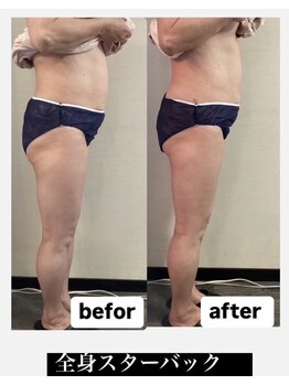 トータルビューティーサロン カノン(Kanon)/痩身コースたった1回の変化写真