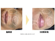 エキュレ ジャーニー トゥ マイ トータル ビューティー(equrer)/おひげ脱毛は1回でも！