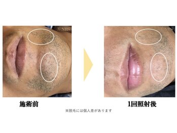 エキュレ ジャーニー トゥ マイ トータル ビューティー(equrer)/おひげ脱毛は1回でも！