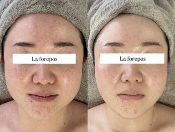 ラ フォルポ 恵比寿(La forepos)/恵比寿ハーブピーリング/小顔