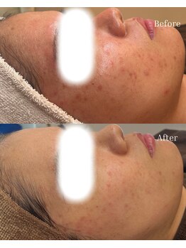 ベリスユイット(BELLIS HUIT)/【剥離なしハーブピーリング】