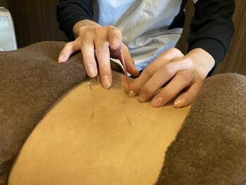 笑顔整骨院の写真/慢性的なコリは鍼で改善◎何をしても改善しなかった方、何をしたらいいか分からない方はお任せください！