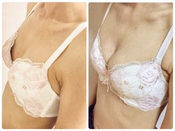 オリーブ 金沢(Olive)/バストアップ★育乳症例