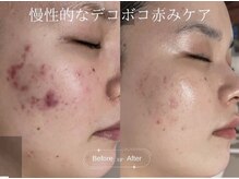 クレア(CLEA)/繰り返す慢性的なニキビケア